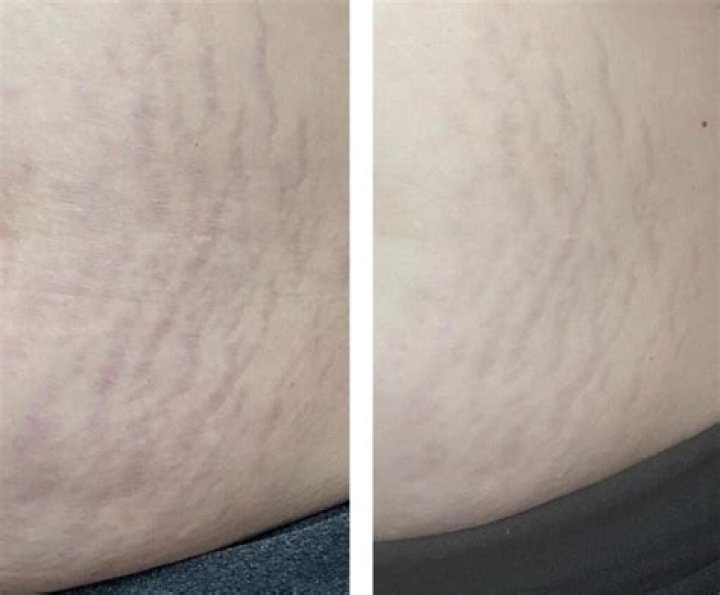 Do hot baths help stretch marks? ·