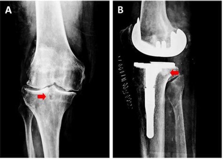Inside The Tibia Case Daniel Photos